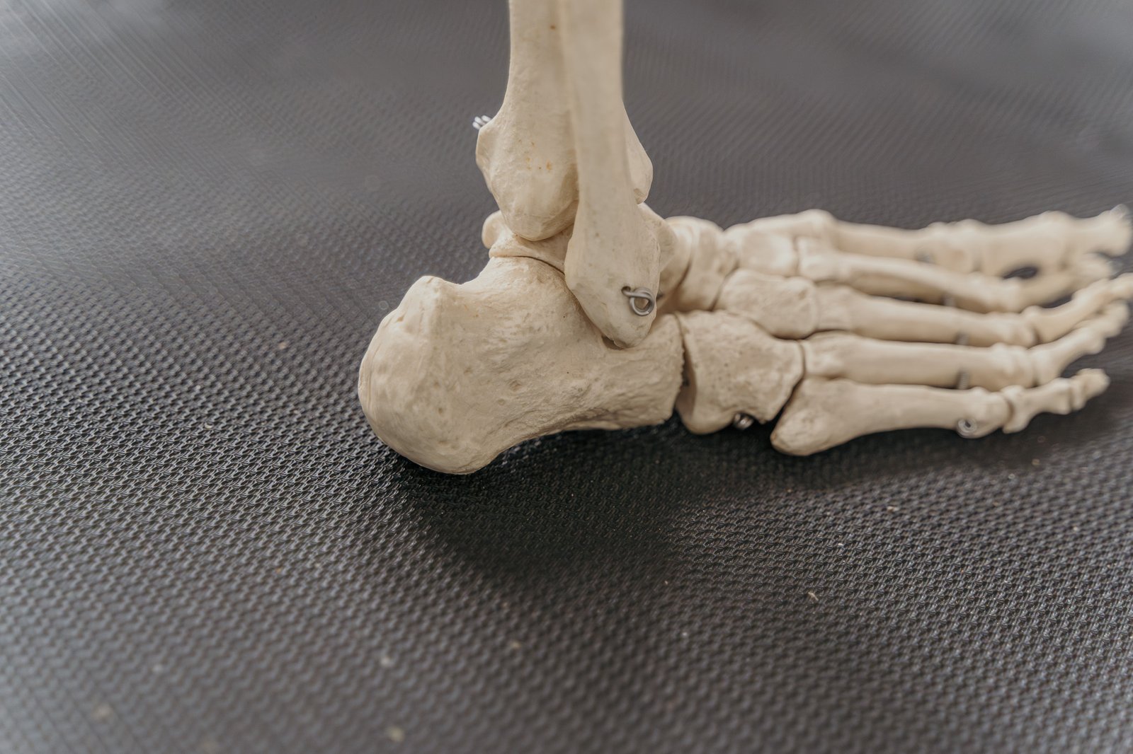 Hielspoor: als elke stap pijn doet